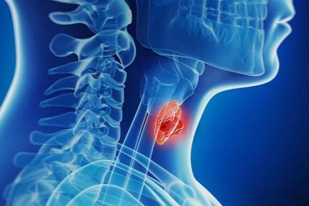 افزایش آمار تشخیص بدخیمیهای تیروئیدی افزایش آمار تشخیص بدخیمیهای تیروئیدی