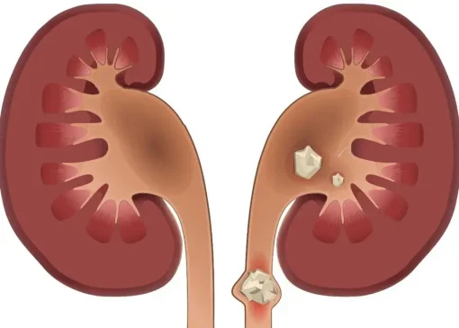 سنگ کلیه چه علائمی دارد؟