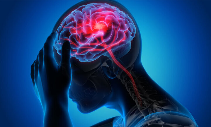 تحریک نخاع به بازیابی قدرت بازو پس از سکته مغزی کمک می کند