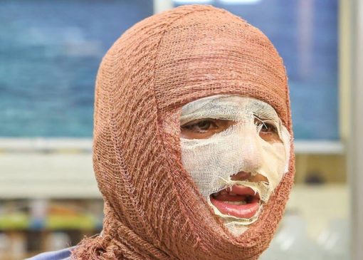 «جان نو» به کمک بیماران سوختگی می‌آید